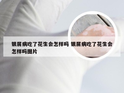 银屑病吃了花生会怎样吗 银屑病吃了花生会怎样吗图片
