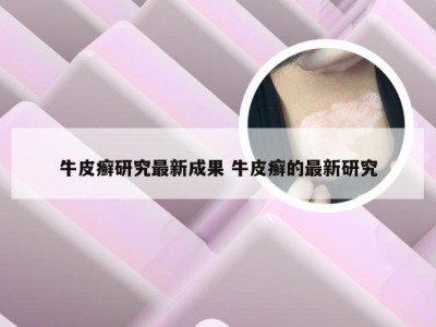 牛皮癣研究最新成果 牛皮癣的最新研究