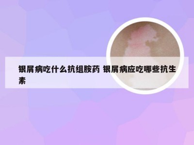 银屑病吃什么抗组胺药 银屑病应吃哪些抗生素