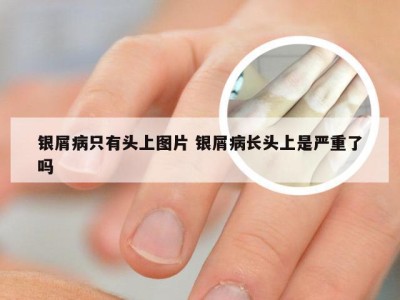 银屑病只有头上图片 银屑病长头上是严重了吗