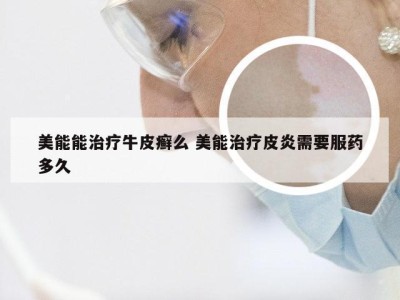 美能能治疗牛皮癣么 美能治疗皮炎需要服药多久