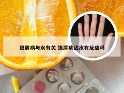 银屑病与水有关 银屑病沾水有反应吗