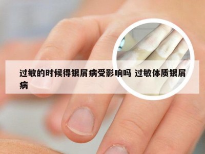 过敏的时候得银屑病受影响吗 过敏体质银屑病