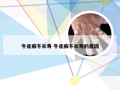 牛皮癣不长寿 牛皮癣不长寿的原因