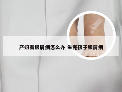 产妇有银屑病怎么办 生完孩子银屑病