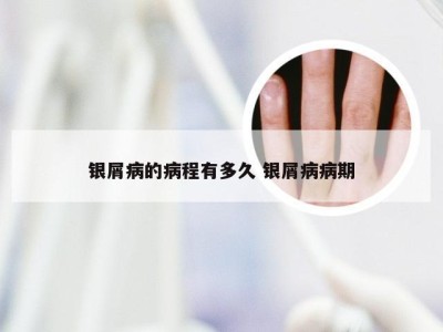 银屑病的病程有多久 银屑病病期