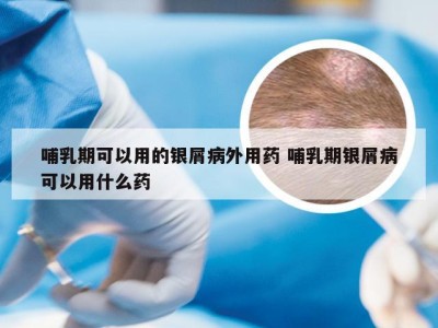 哺乳期可以用的银屑病外用药 哺乳期银屑病可以用什么药