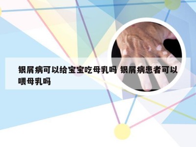 银屑病可以给宝宝吃母乳吗 银屑病患者可以喂母乳吗