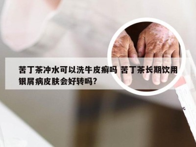 苦丁茶冲水可以洗牛皮癣吗 苦丁茶长期饮用银屑病皮肤会好转吗?