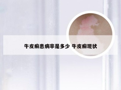 牛皮癣患病率是多少 牛皮癣现状