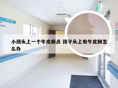 小孩头上一个牛皮癣点 孩子头上有牛皮鲜怎么办