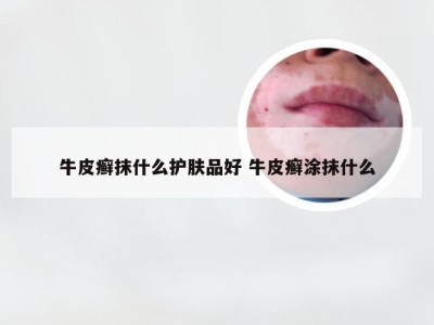 牛皮癣抹什么护肤品好 牛皮癣涂抹什么