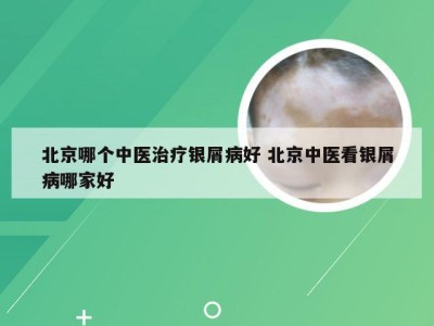 北京哪个中医治疗银屑病好 北京中医看银屑病哪家好