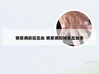 银屑病刮后出血 银屑病扣掉皮出血多