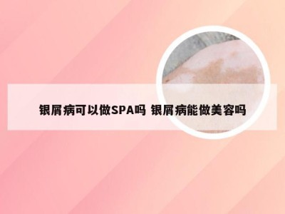 银屑病可以做SPA吗 银屑病能做美容吗