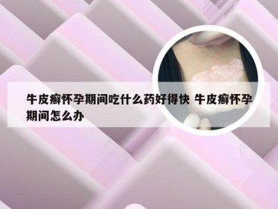 牛皮癣怀孕期间吃什么药好得快 牛皮癣怀孕期间怎么办