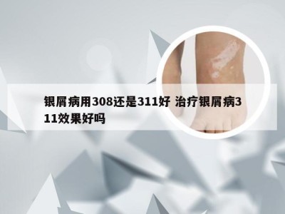 银屑病用308还是311好 治疗银屑病311效果好吗