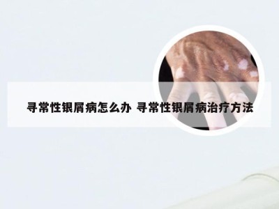 寻常性银屑病怎么办 寻常性银屑病治疗方法