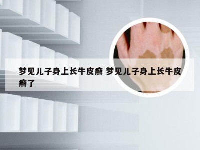 梦见儿子身上长牛皮癣 梦见儿子身上长牛皮癣了