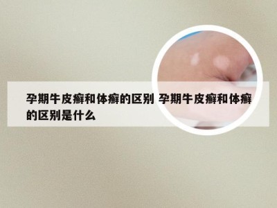孕期牛皮癣和体癣的区别 孕期牛皮癣和体癣的区别是什么