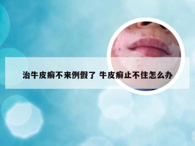治牛皮癣不来例假了 牛皮癣止不住怎么办