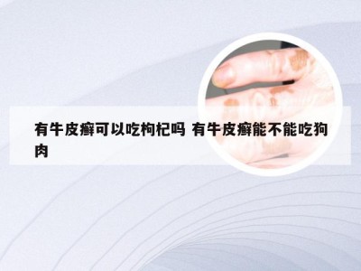 有牛皮癣可以吃枸杞吗 有牛皮癣能不能吃狗肉