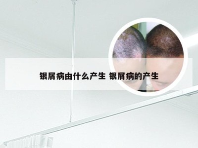 银屑病由什么产生 银屑病的产生