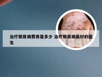 治疗银屑病费用是多少 治疗银屑病最好的医生