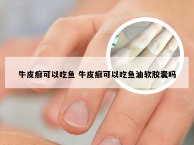 牛皮癣可以吃鱼 牛皮癣可以吃鱼油软胶囊吗