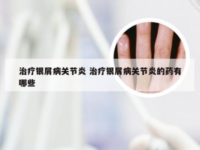 治疗银屑病关节炎 治疗银屑病关节炎的药有哪些