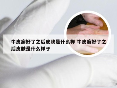 牛皮癣好了之后皮肤是什么样 牛皮癣好了之后皮肤是什么样子