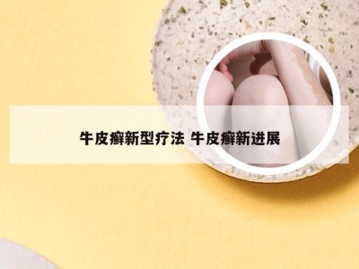 牛皮癣新型疗法 牛皮癣新进展