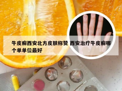 牛皮癣西安北方皮肤称赞 西安治疗牛皮癣哪个单单位最好
