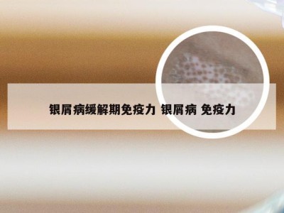 银屑病缓解期免疫力 银屑病 免疫力