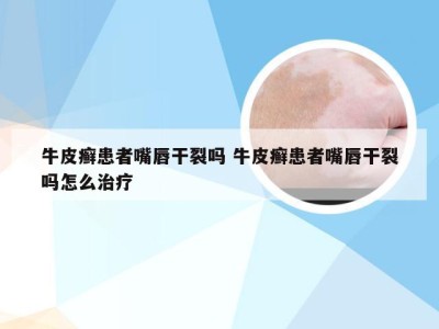 牛皮癣患者嘴唇干裂吗 牛皮癣患者嘴唇干裂吗怎么治疗