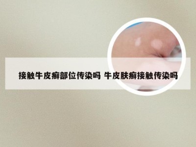 接触牛皮癣部位传染吗 牛皮肤癣接触传染吗