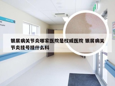 银屑病关节炎哪家医院是权威医院 银屑病关节炎挂号挂什么科