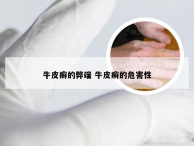 牛皮癣的弊端 牛皮癣的危害性