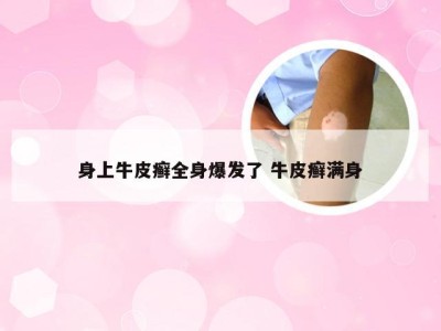 身上牛皮癣全身爆发了 牛皮癣满身