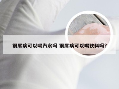 银屑病可以喝汽水吗 银屑病可以喝饮料吗?