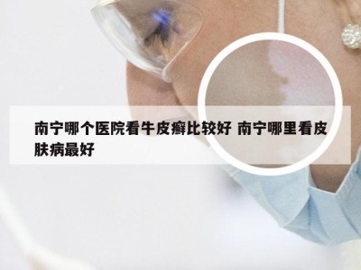 南宁哪个医院看牛皮癣比较好 南宁哪里看皮肤病最好