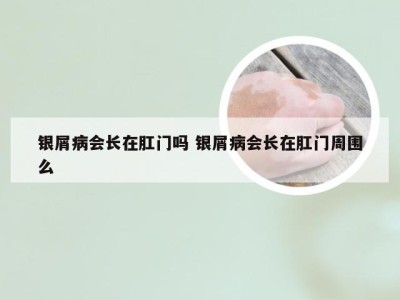 银屑病会长在肛门吗 银屑病会长在肛门周围么