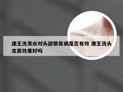 康王洗发水对头部银屑病是否有效 康王洗头皮屑效果好吗