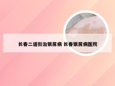 长春二道街治银屑病 长春银屑病医院