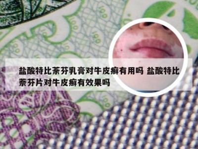 盐酸特比荼芬乳膏对牛皮癣有用吗 盐酸特比萘芬片对牛皮癣有效果吗