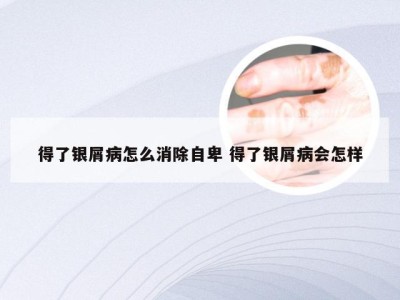 得了银屑病怎么消除自卑 得了银屑病会怎样