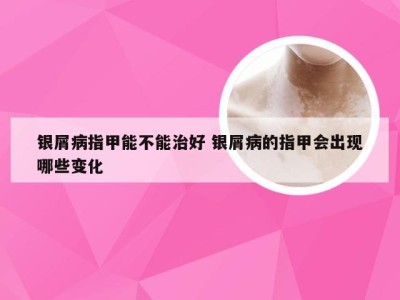 银屑病指甲能不能治好 银屑病的指甲会出现哪些变化