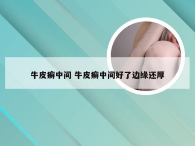 牛皮癣中间 牛皮癣中间好了边缘还厚