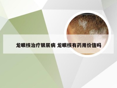 龙眼核治疗银屑病 龙眼核有药用价值吗
