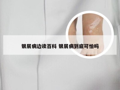 银屑病边读百科 银屑病到底可怕吗